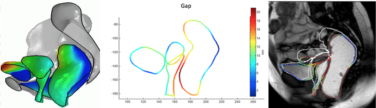 MR Image Registration vs. FE simulation